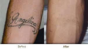 The laser breaks the pigment. 9 Best Laser Tattoo Removal Treatments Styles At Life
