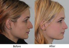 They can look up your nose with a tool called a nasal endoscope to see for sure. 24 Sinus Surgery Before And After Photos Ideas Sinus Surgery Surgery Lipo Before And After