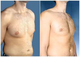 Marital status (never married at higher risk). The Symptoms Causes And Treatments Of Gynecomastia Breast Enlargement In Males