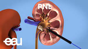 Maybe you would like to learn more about one of these? Perkutane Nephrolitholapaxie Pnl Pi De
