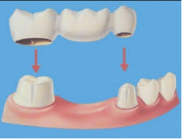 Check spelling or type a new query. 8 Best Tooth Replacement Options For Missing Teeth