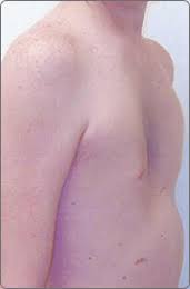 Jecur,oris n lac,lactis n lien,lienis m os,oris n os,ossis n pectus,oris n ren,renis m vas,vasis n viscus,eris n. Pectus Excavatum And Pectus Carinatum Cook Children S