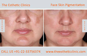 Grate the skin of an orange and make a paste/gel with apart from these home remedies, laser skin pigmentation removal treatment is a very popular option as well. Face Skin Pigmentation Treatment Mumbai Hyperpigmentation Cost India The Esthetic Clinics