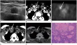 The supraclavicular lymph nodes (often shortened to the supraclavicular nodes) are a paired group of lymph nodes located on each side in the hollow superior to the clavicle, close to the sternoclavicular joint. Jksr Journal Of The Korean Society Of Radiology