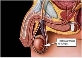 Testicular cancer tends to have a positive prognosis because it can usually be treated successfully. What Does A Testicular Lump Look Feel Like Diagnosis Symptoms Treatments