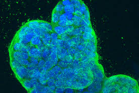 Most breast cancers are invasive. Spread Of Breast Cancer Linked To Newly Discovered Rna Splicing Mechanism Uc San Francisco