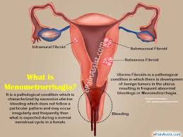 Pada dasarnya haid yang berkepanjangan terjadi 90% karena pendarahan uterus disfungsional atau pendarahan rahim tidak. Masalah Haid Berpanjangan Hilang Dengan Shaklee Pengedar Shaklee Shah Alam