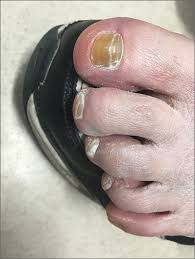 Image result for Pitting nails feet