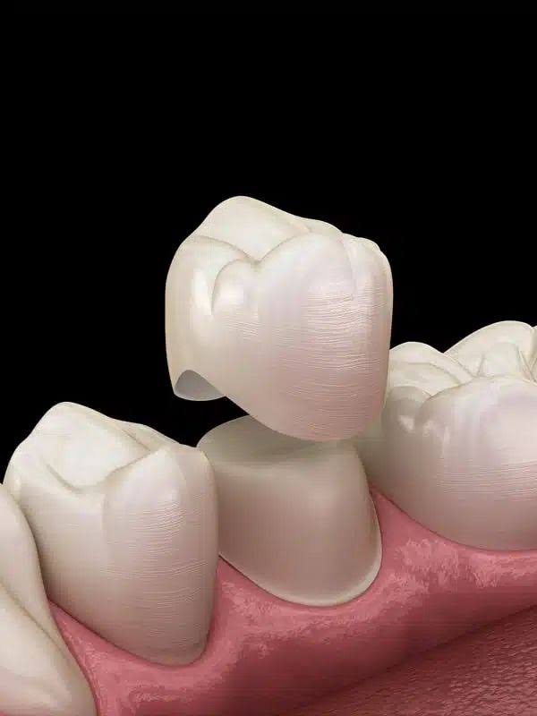 Dental Crowns product image