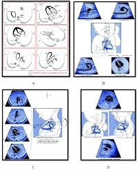 A Selected Views Of Fetal Cardiac Screening Recommended By Isuog B Download Scientific Diagram