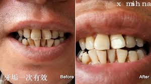 Crest.com has been visited by 10k+ users in the past month How To Remove My Nicotine Stains From Teeth Shareusmile Youtube