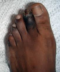 Image result for toe black diabetes