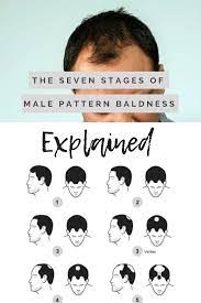 The 7 Stages Of Male Pattern Baldness Explained Skalp Male Pattern Baldness Pattern Baldness Hair Loss Men