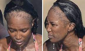 Naomi campbell hair loss report and dr farjo from the farjo hair institute gets interviewed by the presenter. Naomi Campbell S Shocking Bald Patches After Years Of Relying On Hair Extensions Daily Mail Online
