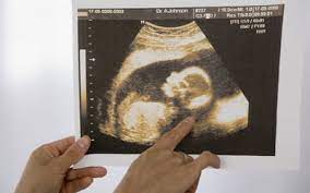 I did have an early scan at 5+5 and everything was fine with a good heartbeat. Ultrasound Accuracy For Predicting Due Dates