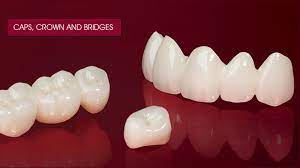 Caps Crown And Bridges Providers In Noida Delhi Ncr Ratra Dental Centre