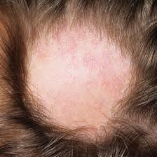 Betamethasone valerate cream may cause some side effects, such as acne, stinging or cracking of the skin, and skin irritation. The Information Alopecia Areata Pulse Today