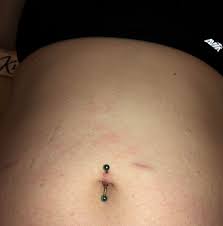 Weird Belly Button Piercing Was Pierced April 6 The Top Hole Looks Fine But The Bottom Hole Has This Weird Bump That Stays Crusty And Bleeds A Bit If I Mess With