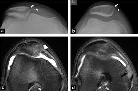 The term retinaculum is new latin, derived from the latin verb retinere (to retain). Avulsion Of Patellar Retinaculum In A 16 Year Old Patient Who Sustained Download Scientific Diagram