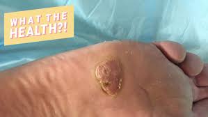 A cancer can grow into,or begin to push on nearby organs, blood vessels, and nerves. This Man Discovered The 20 Year Old Wart On His Foot Was Actually Skin Cancer My Best Medicine