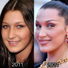 Bella Hadid Rhinoplasty