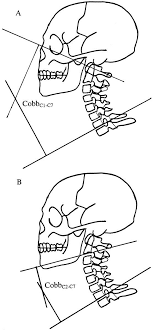 Maybe you would like to learn more about one of these? Four Line Cobb Method On Lateral Cervical Radiograph A The Four Line Download Scientific Diagram