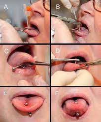 The most preferred jewelry used is barbells. Medical Tongue Piercing Development And Evaluation Of A Surgical Protocol And The Perception Of Procedural Discomfort Of The Participants Journal Of Neuroengineering And Rehabilitation Full Text