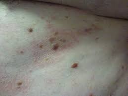 Image result for dermatitis contacta allergica