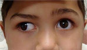 Wall Eyed From Fever By Mary Beth Keane Eye Doctor Eyes Eye Treatment