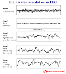 Types And The Stages Of Sleep Sleep Apnea Cure For Sleep Apnea Brain Waves
