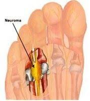 Pin On Custom Made Orthotics