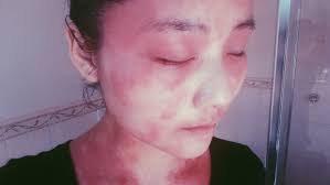 Help ITSAN: raising awareness for Red Skin Syndrome