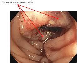 Cancer du côlon (cancer colorectal) | SNFGE