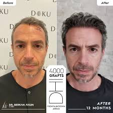 Pablo's Hair Transplant in Turkey: Before & After Results