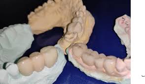 The component of a removable partial denture that assist the direct retainer(s) in. Classifications Of Fixed Partial Dentures Or Bridges
