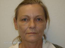 Facelift Photo Gallery