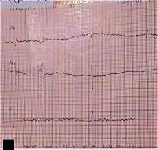 Ca urmare, rupte proprietăți contractile inima, dezvolta bloc de ramură de conducere pachet duce la incetinirea impuls electric (blocada incompleta de gradul i). Bloc Atrioventricular Congenital La Nou NÄscut Din MamÄ Cu Lupus Eritematos Sistemic Prezentare De Caz
