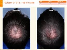 Today, i wanted to discuss about follica. Aclaris Announces Positive 6 Month Results For Androgenetic Alopecia Hair Loss Cure 2020