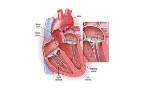 These flaps normally help seal or open the valve. Minimally Invasive Mitral Valve Repair