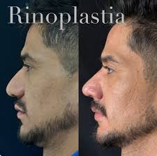 La rinoplastía está diseñada para realzar la forma y función de tu nariz,  siempre respetando tu naturalidad. ✨ ¿Qué esperas para agendar tu cita y  dar el siguiente paso hacia tu mejor