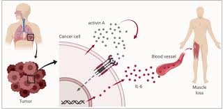 Image result for Cachexia in Cancer