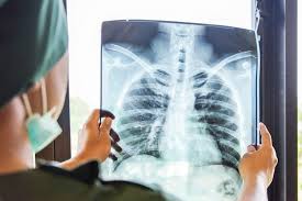 And if it is, even a little bit, how does it get out? A Woman Seemed Recovered From Covid 19 Then Both Her Lungs Collapsed Live Science