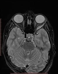 Idiopathic Orbital Inflammation Radiology Case Radiopaedia Org