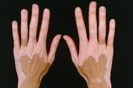 Vitiligo prevalence study in shaanxi province. Vitiligo Nhs