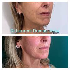 Dr Laurent Dumas Vidal (@dr_laurent_dumas_vidal) · Instagram photos and  videos