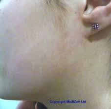 It's safe for use in a variety of areas, including legs, underarms, bikini, stomach, arms, and even your delicate facial skin. Laser Ipl Hair Removal Treatment Cost Side Effects Information