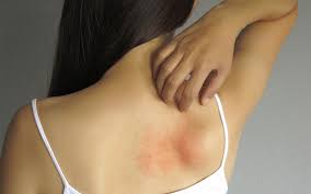 This can help your skin contact your doctor immediately if you experience severe itchiness without any bites, wounds, or rash. Heat Rash Treatment The 4 Best Over The Counter Options A Spy Guide Spy