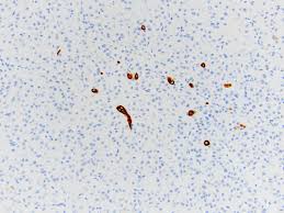 Asbestos, chromosomal deletions, and tumor supressor gene alterations in human malignant mesothelioma. Pathology Outlines Cytokeratin 7 Ck7 K7