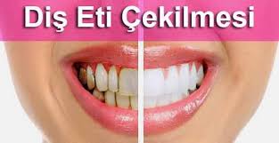 Dis Eti Cekilmesi Neden Olur Ne Iyi Gelir Dis Eti Cekilmesi Neden Olur Bitkisel Cozum Dis Eti Cekilmesi Dogal Cozum Dis Dis Dogal Dis Beyazlatma Saglik Bakim
