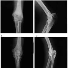 The olecranon /oʊˈlɛkrənɒn/, from the greek olene meaning elbow and kranon meaning head, is a large, thick, curved bony eminence of the ulna, a long bone in the forearm that projects behind the elbow. Representative X Ray Films Of Olecranon Fracture Patients Before And Download Scientific Diagram